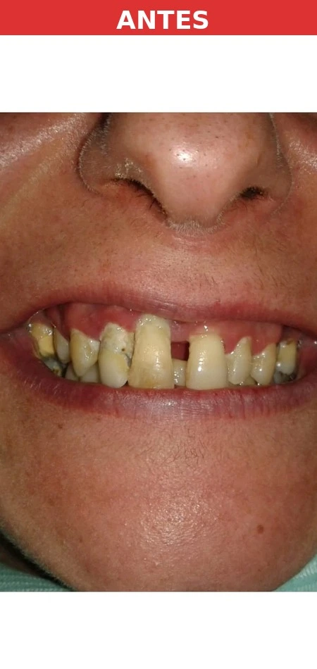 Paciente antes del implante dental Aluche
