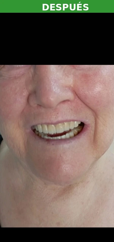 Resultado implante dental Campamento — después
