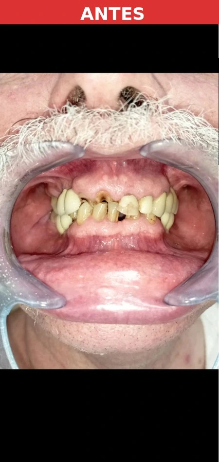 Paciente antes del implante dental Carabanchel
