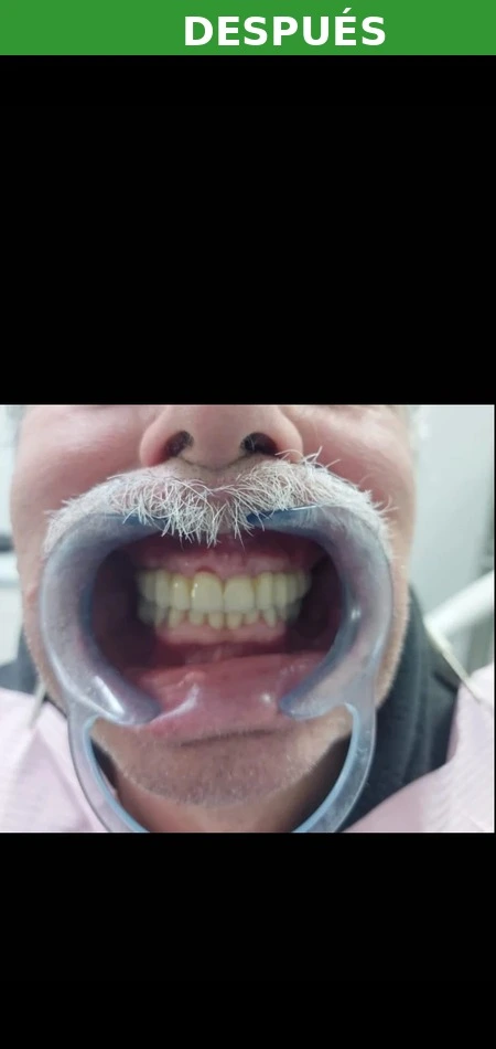 Resultado implante dental Carabanchel — después
